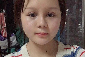 上海時光整形外科醫(yī)院李靜林醫(yī)生顴骨手術(shù)果太好了