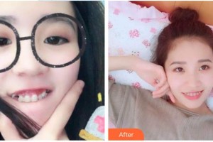 景德鎮(zhèn)圣嘉麗醫(yī)療美容門診部劉志強(qiáng)整形價(jià)格表附牙齒隱形矯正案例展示