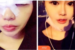 景德鎮(zhèn)市醫(yī)院賀恒偉整形價(jià)格表附眼部綜合案例展示