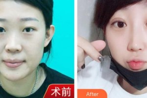 潮州博蘭雅醫(yī)療美容門診部倪絢整形價格表附鼻部綜合案例展示