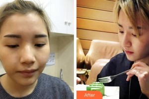 潮州博蘭雅醫(yī)療美容門診部胡龍整形價格表附鼻部綜合案例展示