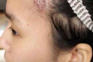 珠海人民醫(yī)院植發(fā)果怎么樣附2021價格表專家介紹