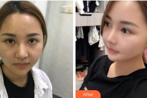 慈溪圣愛醫(yī)院整形美容科陶衛(wèi)整形價格表附鼻部綜合案例展示