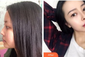 慈溪悅爾醫(yī)學(xué)美容醫(yī)院展望整形價格表附鼻部綜合案例展示