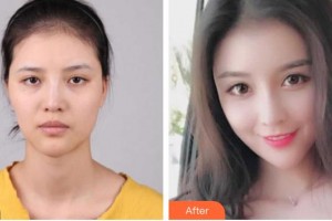 慈溪悅爾醫(yī)學(xué)美容醫(yī)院張庸柱整形價格表附鼻部綜合案例展示