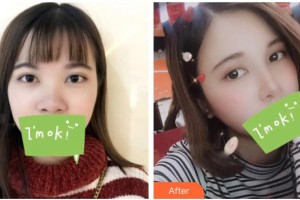 慈溪悅爾醫(yī)學(xué)美容醫(yī)院趙天宇整形價格表附鼻部綜合案例展示