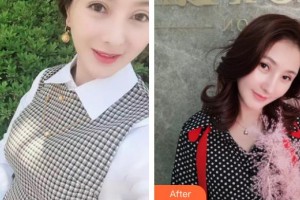 慈溪陽明醫(yī)療美容門診部黃雪麗整形價格表附鼻部綜合案例展示