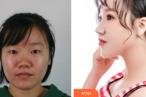 東陽吳少珍醫(yī)學(xué)美容診所吳少珍整形價格表附耳軟骨復(fù)合隆鼻案例展示