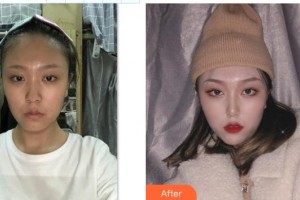 東陽麗萊醫(yī)療美容醫(yī)院顏正安整形價格表附鼻部綜合案例展示