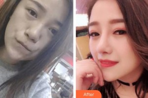 東陽市人民醫(yī)院整形外科呂忠整形價格表附鼻部綜合案例展示