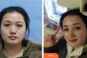 東北國際醫(yī)院整形美容再生醫(yī)學(xué)中心邱濤整形價格表附硅膠隆鼻案例展示