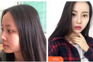 靖江三禾醫(yī)療整形美容醫(yī)院金孝敏整形價格表附鼻部綜合案例展示