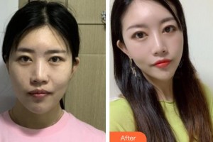 溫嶺整形美容醫(yī)院王光強整形價格表附熱瑪吉案例展示