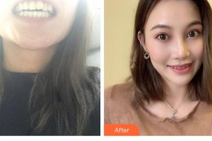 溫嶺口腔醫(yī)院顧偉煒整形價格表附牙齒隱形矯正案例展示