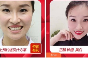 溫嶺口腔醫(yī)院葉惠挺整形價格表附隱形托槽矯正案例展示