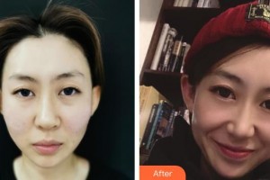 延吉李京云整形美容門診部樸錦錫整形價格表附埋線提升案例展示