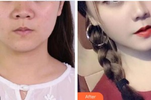 延吉尹世整形美容醫(yī)院尹慶愛整形價格表附激光美膚激光案例展示