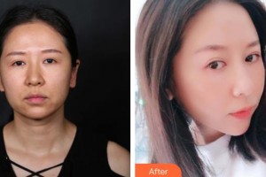 延吉趙美花保健醫(yī)學美容醫(yī)院金恩華整形價格表附埋線提升案例展示