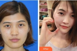 延吉趙美花保健醫(yī)學美容醫(yī)院安香花整形價格表附埋線提升案例展示