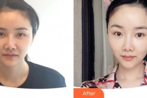 延吉董昌林醫(yī)學美容醫(yī)院董蓮花整形價格表附埋線提升案例展示