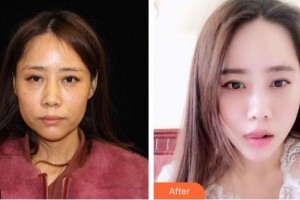 延吉趙美花保健醫(yī)學美容醫(yī)院許一整形價格表附埋線提升案例展示