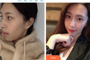 金壇美爾惠醫(yī)療美容診所曹江虹整形價格表附埋線提升案例展示