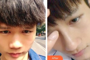 延安大學(xué)附屬醫(yī)院燒傷整形科楊喜明整形價格表附鼻部綜合案例展示