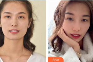 陽(yáng)春口腔醫(yī)院張金望整形價(jià)格表附牙齒隱形矯正案例展示