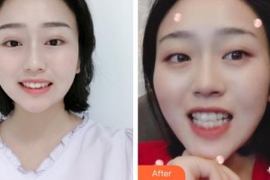 云浮市人民醫(yī)院燒傷整形手外科鐘子敏整形價(jià)格表附牙齒隱形矯正案例展示