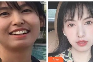 鄧州市第三人民醫(yī)院醫(yī)學(xué)美容整形科范喜明整形價(jià)格表附金屬托槽矯正案例展示