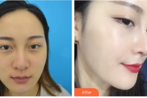 興義時(shí)光整形美容醫(yī)院劉自成整形價(jià)格表附肋軟骨隆鼻案例展示