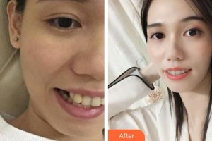 河源市人民醫(yī)院燒傷整形科陳劍平整形價(jià)格表附牙齒隱形矯正案例展示