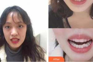 河源拜博東華口腔醫(yī)院黎洪強(qiáng)整形價(jià)格表附美白劑美白牙齒案例展示