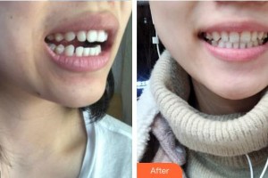 河源曙光醫(yī)療美容門診部許立波整形價(jià)格表附牙貼面案例展示