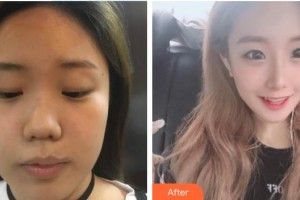 河源曙光醫(yī)療美容門診部何為整形價(jià)格表附牙齒隱形矯正案例展示