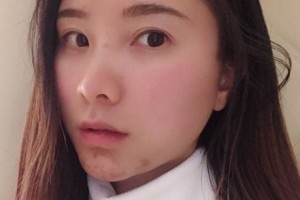 鄭州美立方醫(yī)院怎么樣？熱瑪吉2021價(jià)格分享附案例