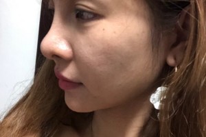 邵逸夫醫(yī)院環(huán)境怎么樣？熱瑪吉價(jià)格表和術(shù)后果