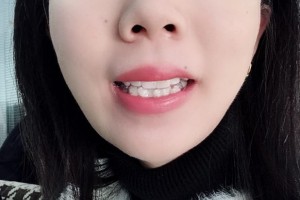 臨沂市人民醫(yī)院口腔正畸怎么樣附果圖|醫(yī)生推薦