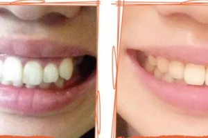 西南醫(yī)科大學(xué)附屬口腔醫(yī)學(xué)院附屬口腔醫(yī)院醫(yī)療美容科趙威整形價(jià)格表附牙齒陶瓷矯正案例展示