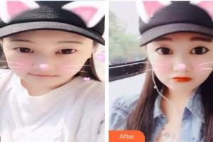 西南醫(yī)科大學(xué)附屬醫(yī)院整形燒傷外科耿康整形價(jià)格表附埋線提升案例展示