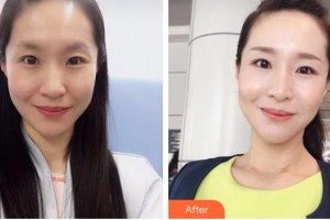 瀏陽(yáng)康美醫(yī)療美容門(mén)診部宋志勇整形價(jià)格表附埋線提升案例展示