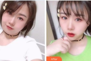 汪蓓青整形價(jià)格表附熱拉提案例展示