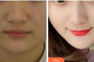 吳俊勇整形價(jià)格表附埋線提升案例展示