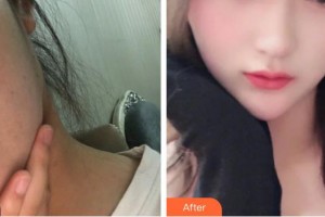 李國(guó)偉整形價(jià)格表附激光美膚激光案例展示