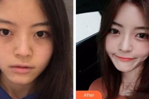 整形價格表附	項目分類	鼻部整形案例展示