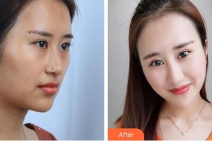 芮昊整形價格表附鼻部綜合案例展示