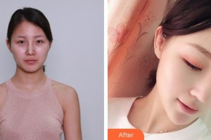 王善良整形價格表附硅膠隆鼻案例展示