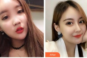 廣州市越秀區(qū)婦幼保健院整形美容科江肖興整形價(jià)格表附鼻部綜合案例展示