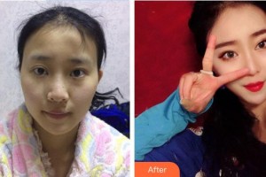 吉首希美醫(yī)療美容門(mén)診部代其超整形價(jià)格表附鼻部綜合案例展示