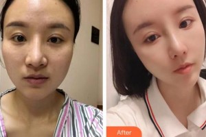 都勻利美康醫(yī)療美容門診部張會英整形價格表附耳軟骨復(fù)合隆鼻案例展示